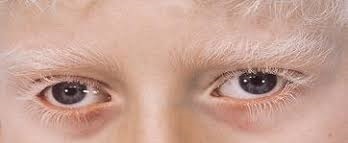 پرسش و پاسخ های متداول درمورد آلبینیسم چشمی (OA) و چشمی-پوستی (OCA)   