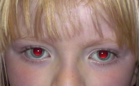 آلبینیسم چشمی(Ocular Albinism)