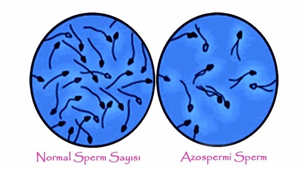 آزواسپرمی(Azoospermia)