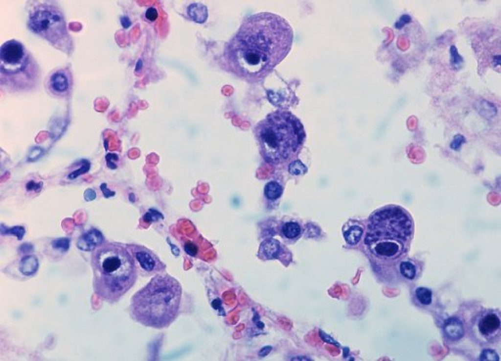 شیوع وجود آنتی ژن سیتومگالوویروس (CMV) در بیماران روماتوئیدی