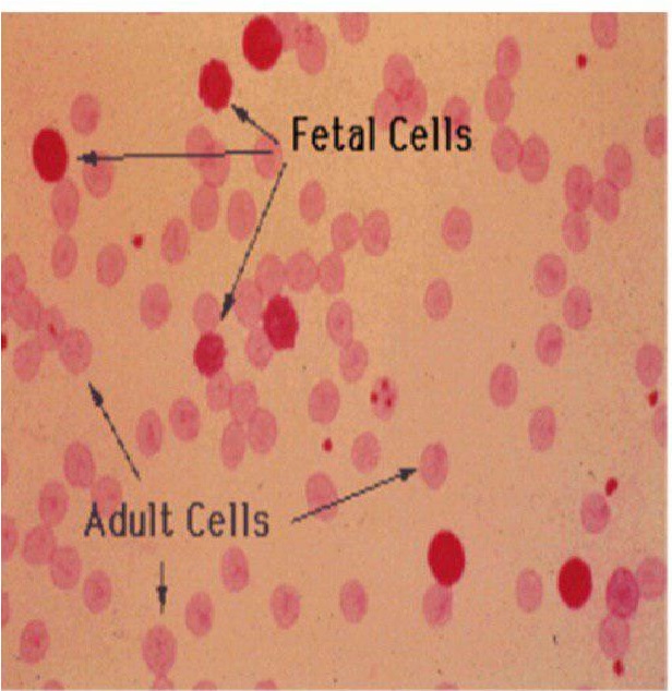 خونریزی جنینی - مادری (FMH) چیست؟ 