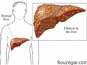 انواع کبد چرب fatty liver 